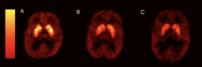 S4-bindinger - scanning af hjernen
